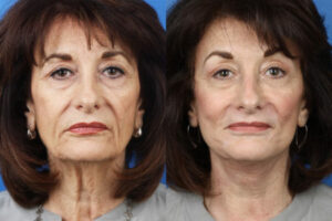 Benefits and Goals of Rhinoplasty