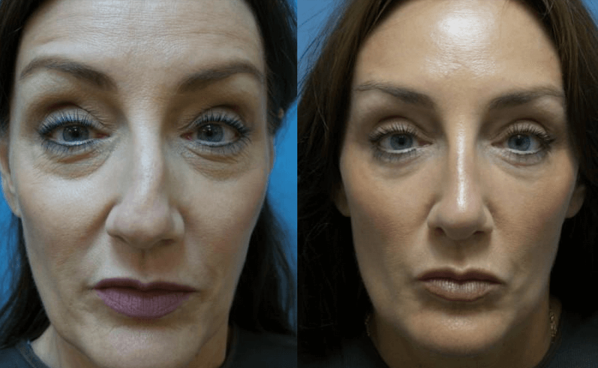Additional Costs In Rhinoplasty