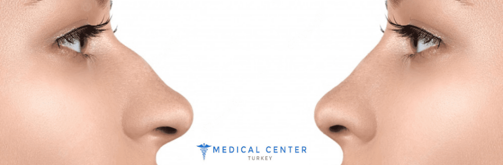 Affordable Rhinoplasty Options