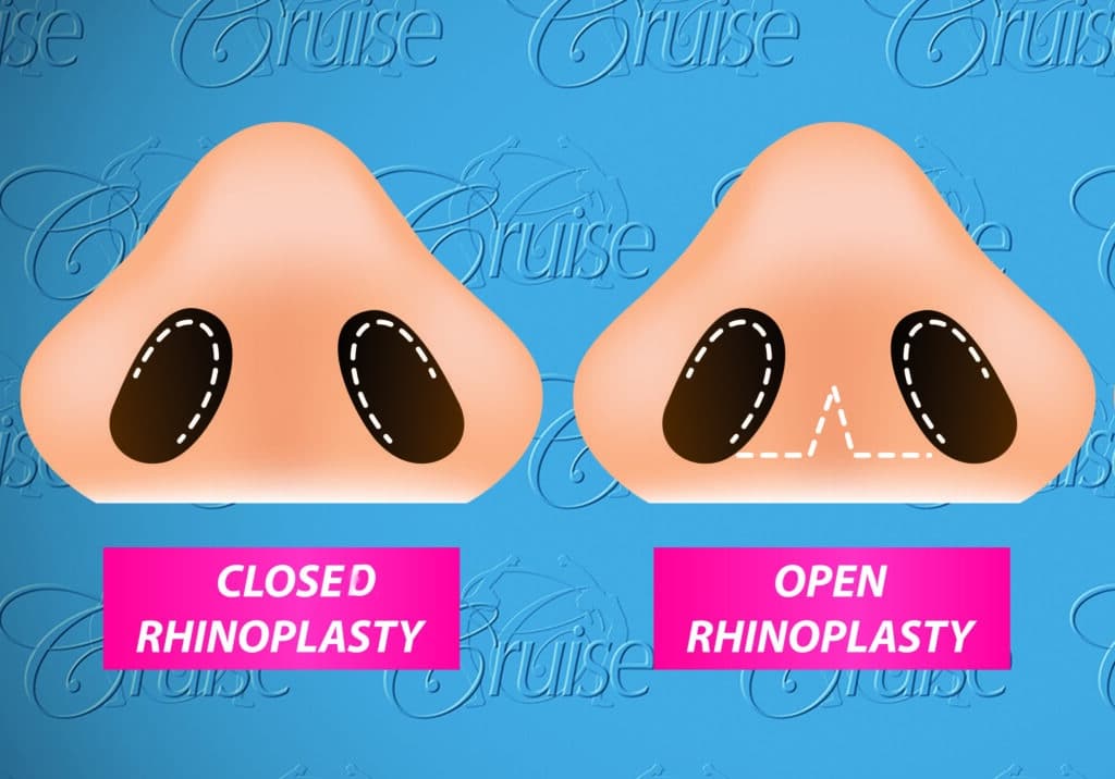 Affordable Rhinoplasty Options