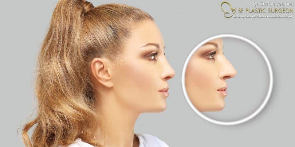 Calculating Total Rhinoplasty Costs