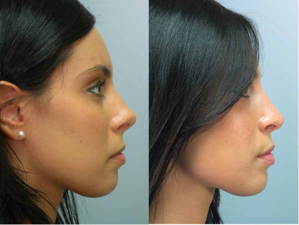 Cost Of Nose Job