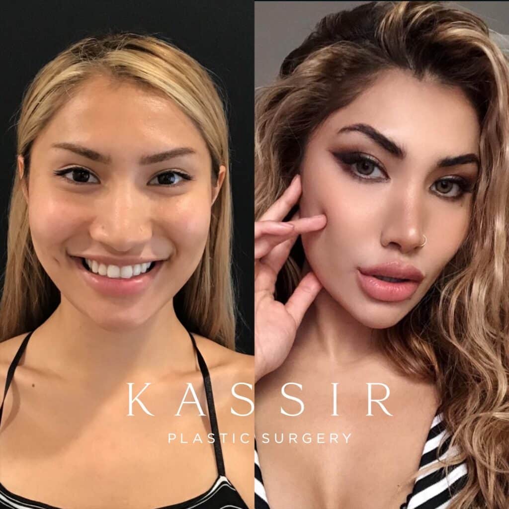 Cost Of Nose Job