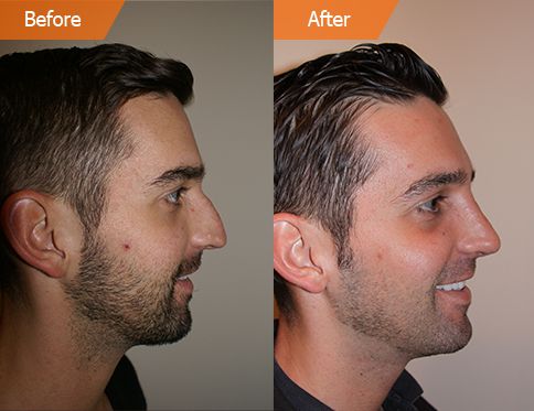 Financing Rhinoplasty