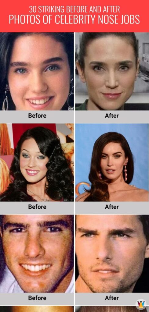 Rhinoplasty Costs Albuquerque New Mexico