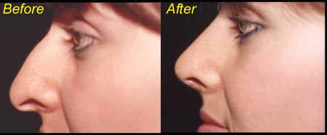 Rhinoplasty Costs Albuquerque New Mexico