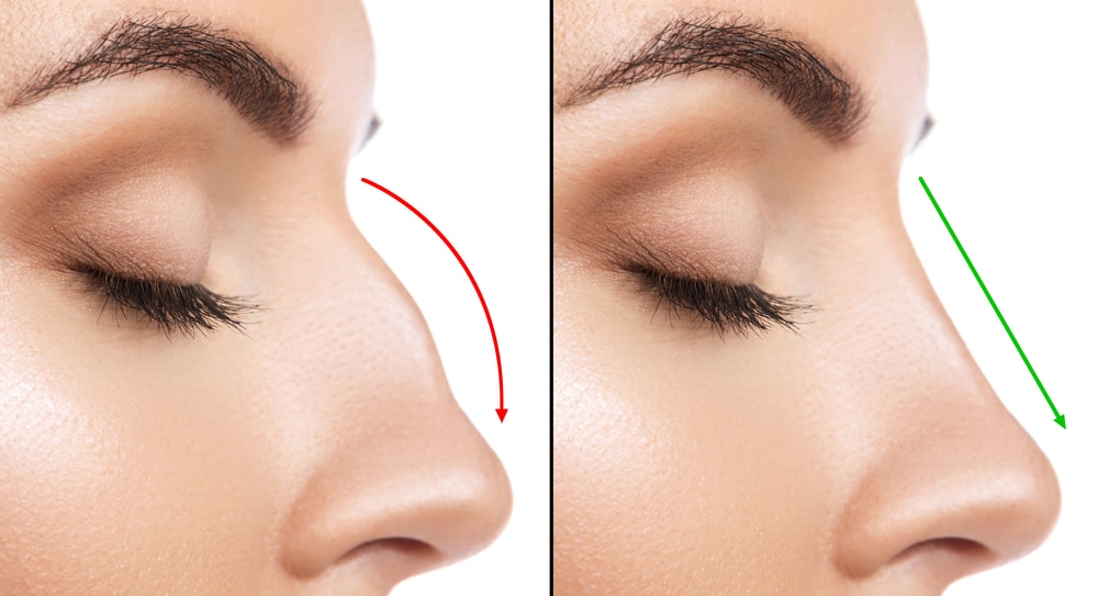Rhinoplasty Costs Atlanta Georgia