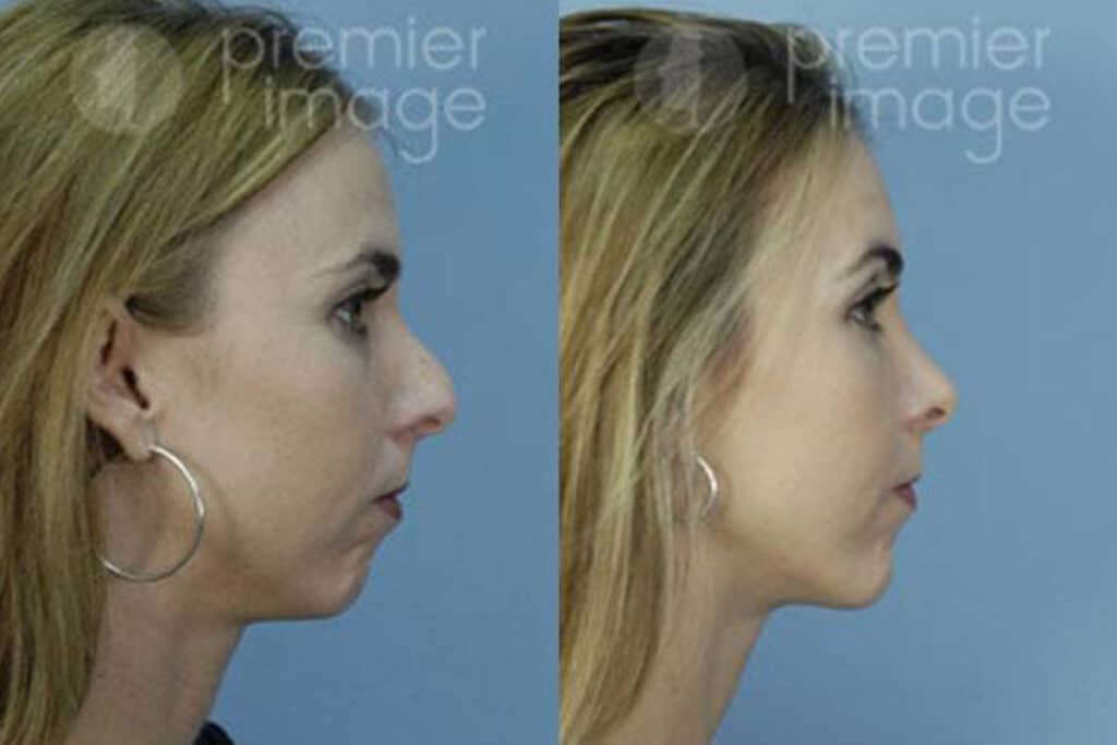 Rhinoplasty Costs Atlanta Georgia
