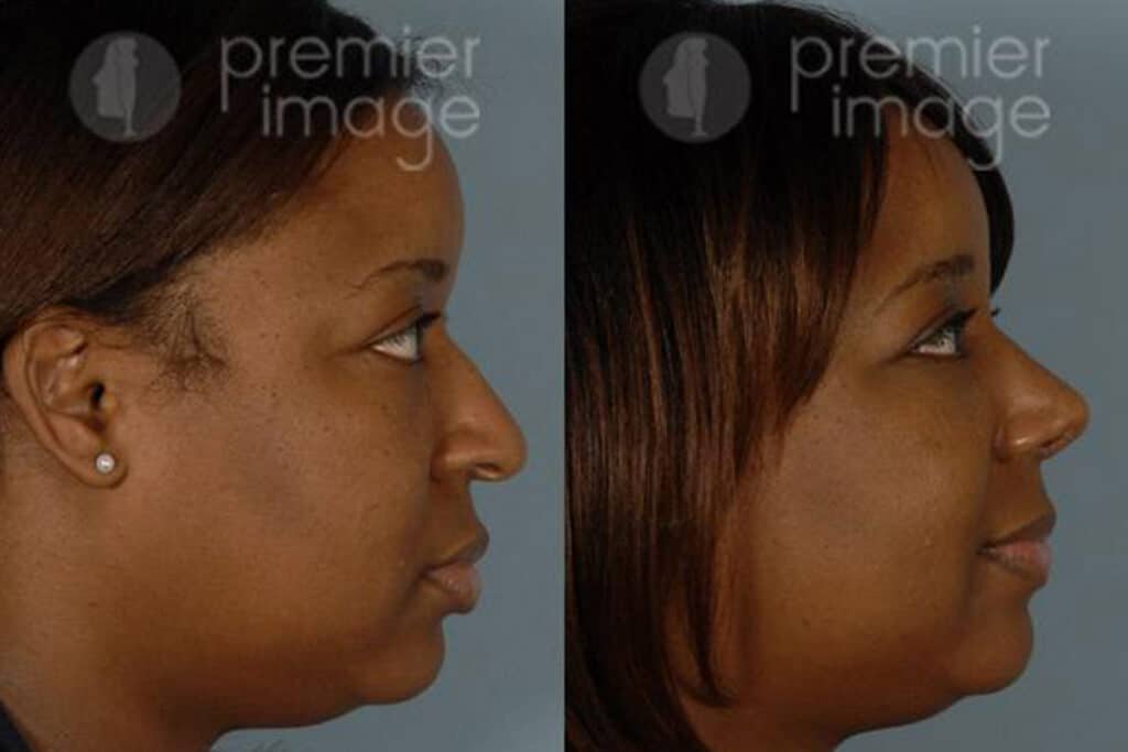 Rhinoplasty Costs Atlanta Georgia