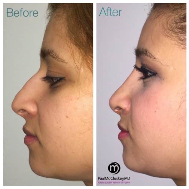 Rhinoplasty Costs Atlanta Georgia