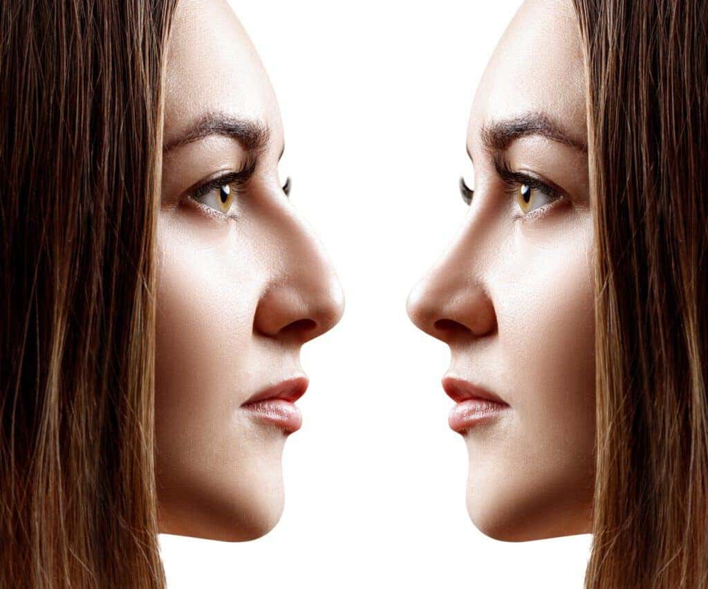 Rhinoplasty Costs Austin Texas