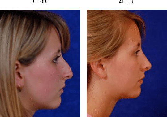 Rhinoplasty Costs Austin Texas