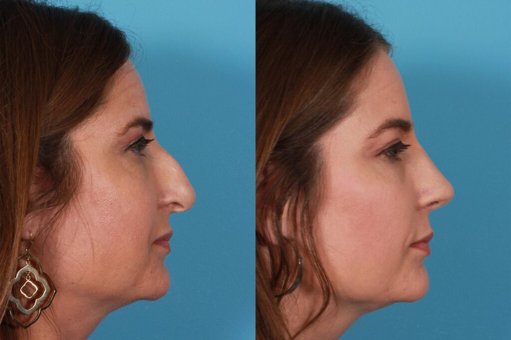 Rhinoplasty Costs Austin Texas