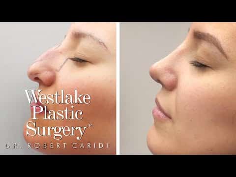 Rhinoplasty Costs Austin Texas