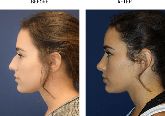 Rhinoplasty Costs Austin Texas