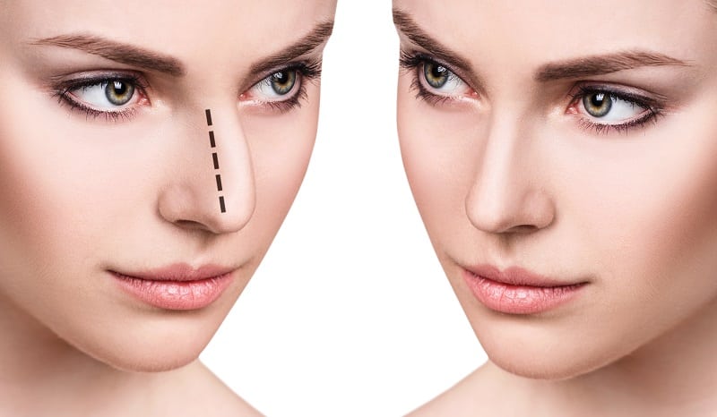 Rhinoplasty Costs Baltimore Maryland