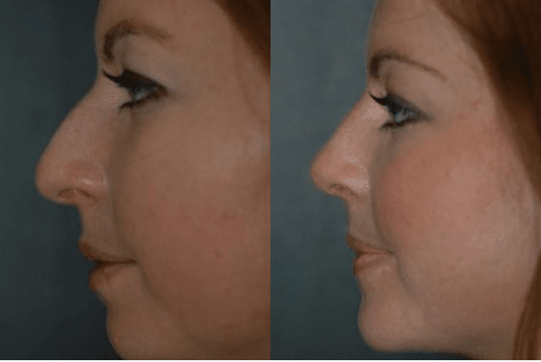 Rhinoplasty Costs By Surgeon’s Experience
