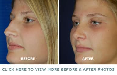 Rhinoplasty Costs Charlotte North Carolina