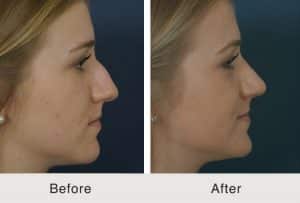 rhinoplasty costs charlotte north carolina 2