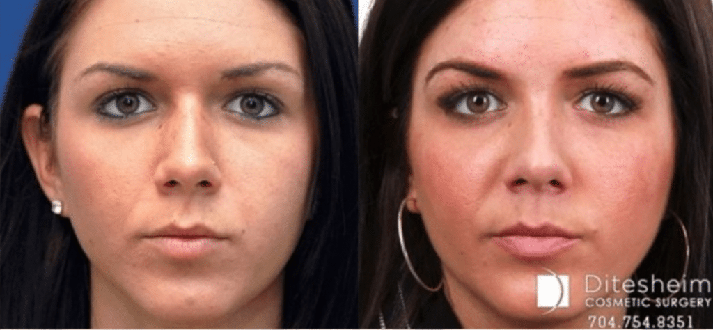 Rhinoplasty Costs Charlotte North Carolina