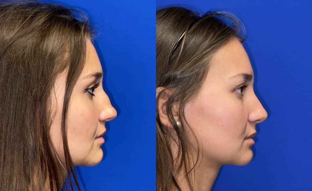 Rhinoplasty Costs Chicago Illinois