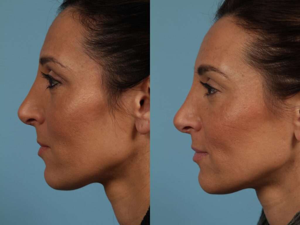 Rhinoplasty Costs Chicago Illinois