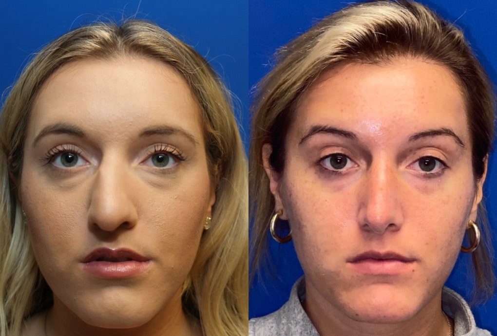 Rhinoplasty Costs Chicago Illinois