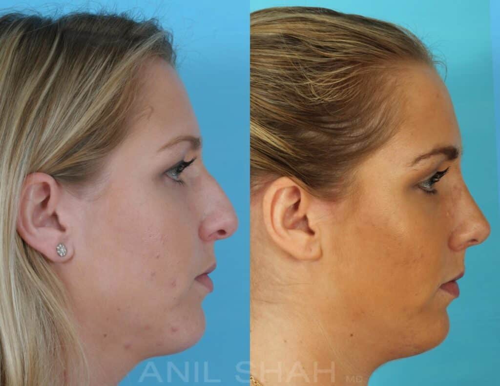 Rhinoplasty Costs Chicago Illinois