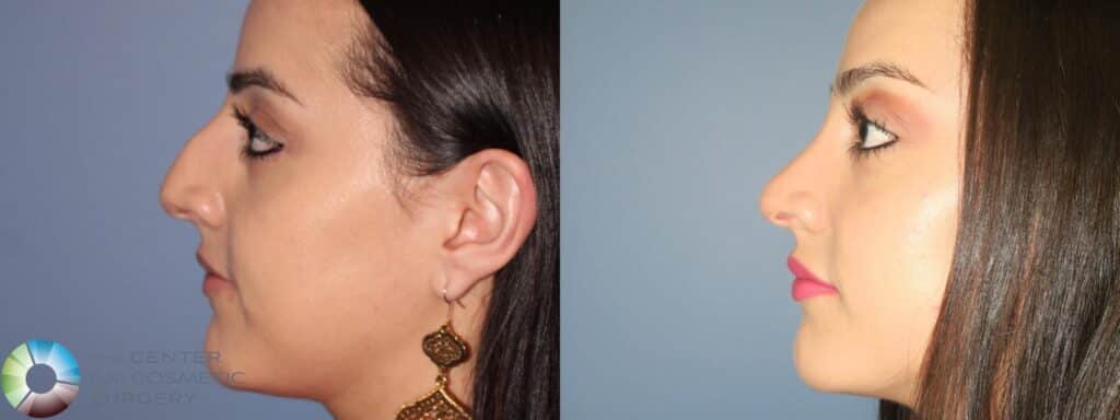 Rhinoplasty Costs Colorado Springs Colorado Rhinoplasty Costs Colorado Springs Colorado