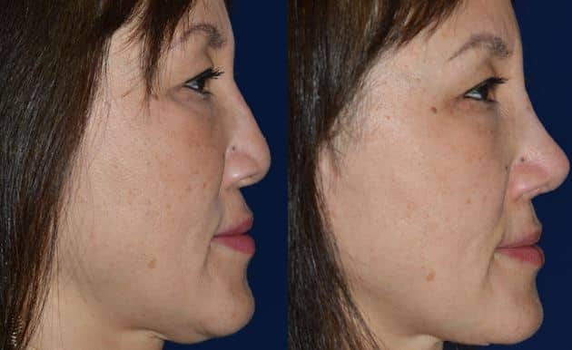 Rhinoplasty Costs Colorado Springs Colorado Rhinoplasty Costs Colorado Springs Colorado