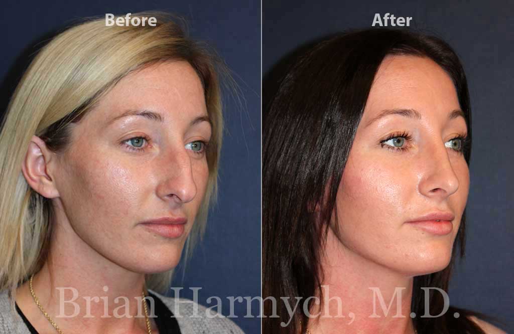 Rhinoplasty Costs Columbus Ohio
