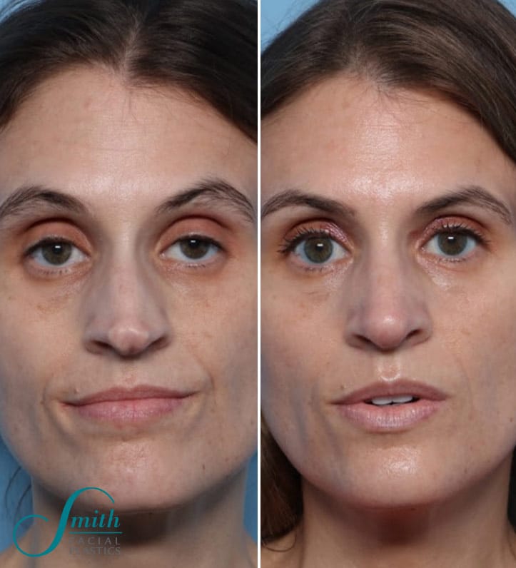 Rhinoplasty Costs Columbus Ohio