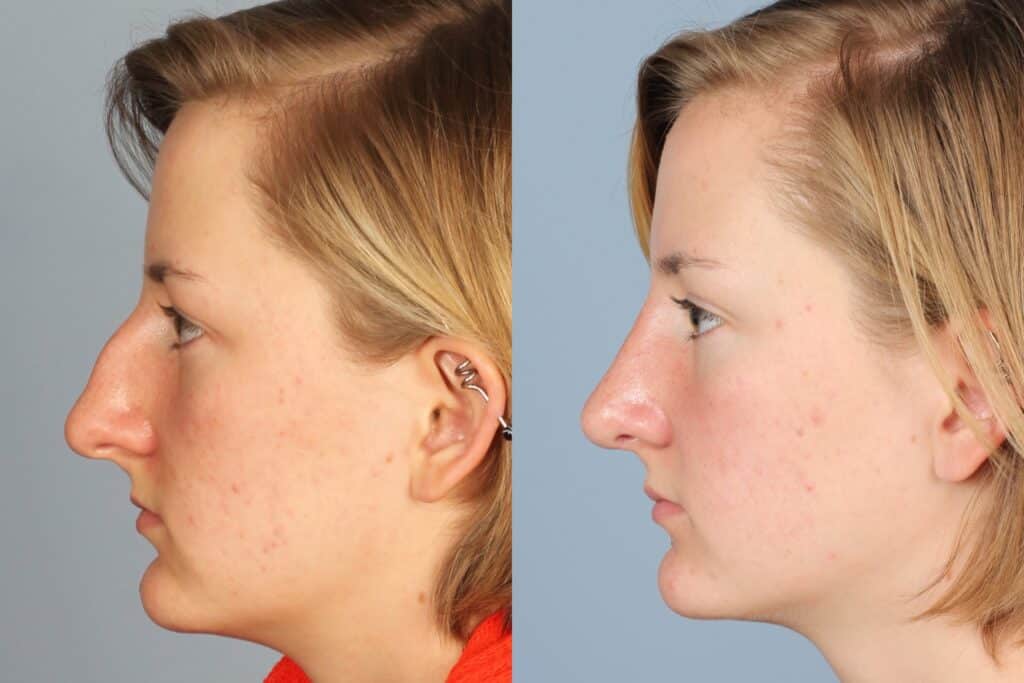 Rhinoplasty Costs Denver Colorado