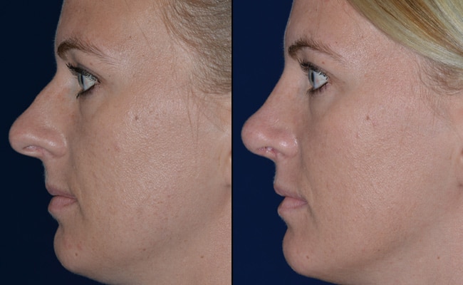 Rhinoplasty Costs Denver Colorado