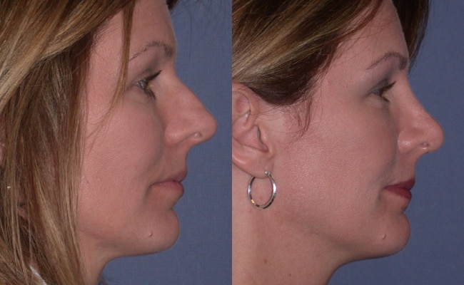 Rhinoplasty Costs Denver Colorado
