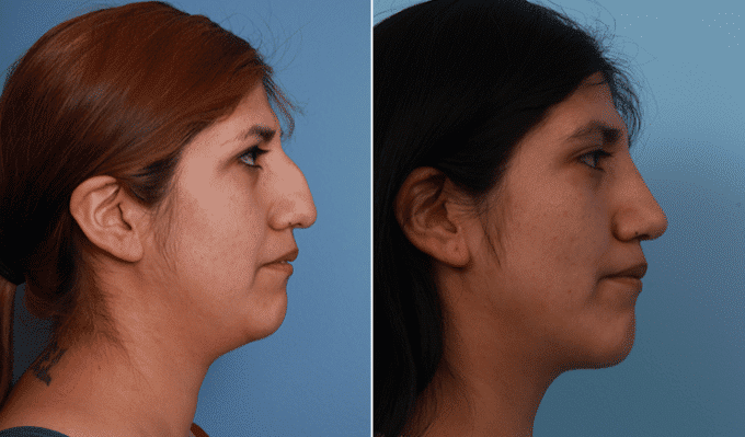 Rhinoplasty Costs Denver Colorado