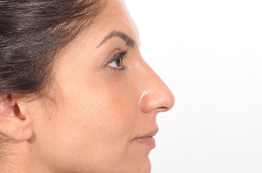Rhinoplasty Costs Detroit Michigan Rhinoplasty Costs Detroit Michigan