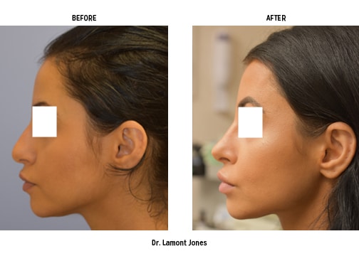 Rhinoplasty Costs Detroit Michigan Rhinoplasty Costs Detroit Michigan