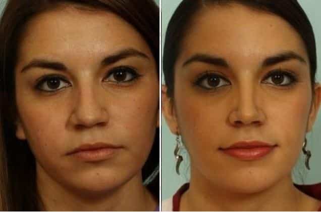 Rhinoplasty Costs El Paso Texas