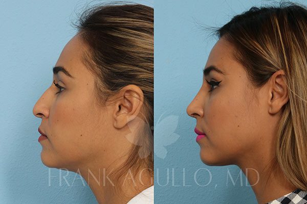 Rhinoplasty Costs El Paso Texas