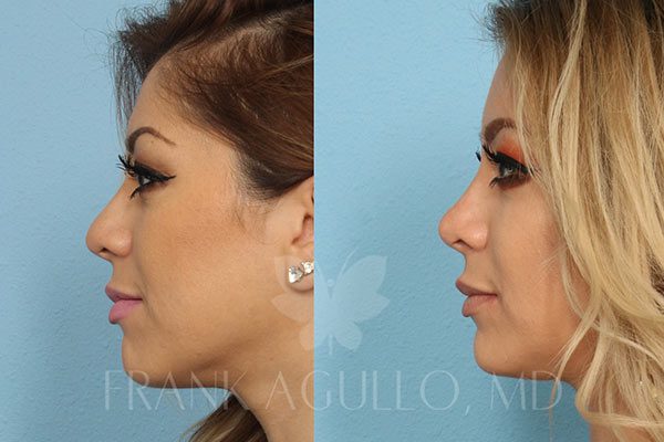 Rhinoplasty Costs El Paso Texas