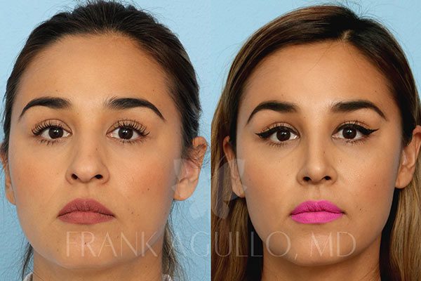 Rhinoplasty Costs El Paso Texas
