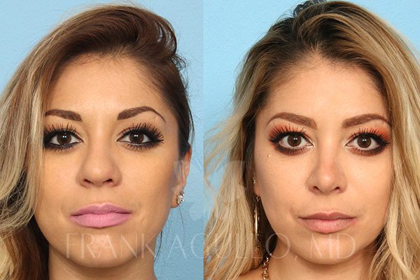 Rhinoplasty Costs El Paso Texas