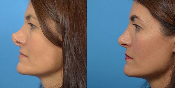 Rhinoplasty Costs Fort Worth Texas Rhinoplasty Costs Fort Worth Texas