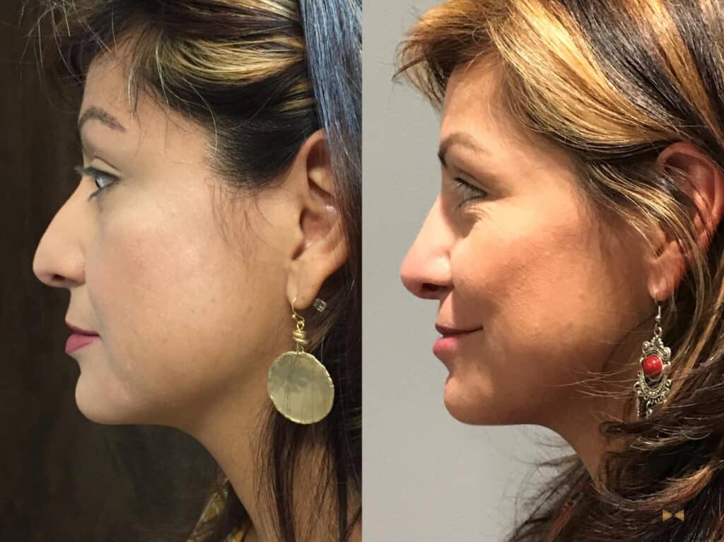 Rhinoplasty Costs Fort Worth Texas Rhinoplasty Costs Fort Worth Texas