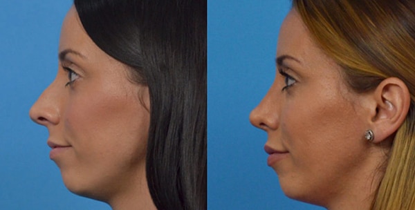 Rhinoplasty Costs Fort Worth Texas Rhinoplasty Costs Fort Worth Texas