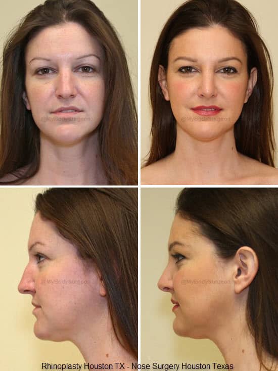 Rhinoplasty Costs Houston Texas Rhinoplasty Costs Houston Texas