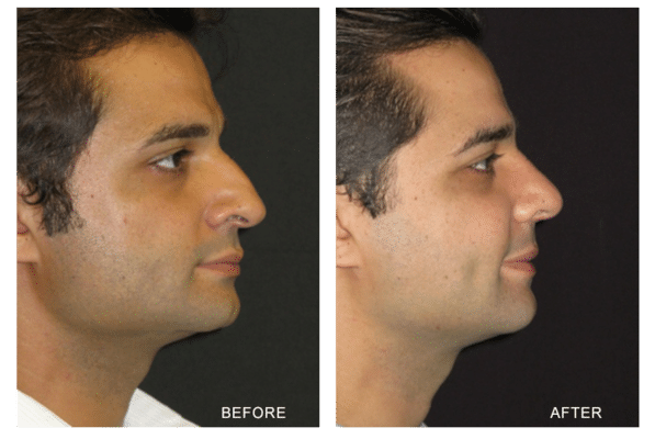 rhinoplasty costs houston texas 1