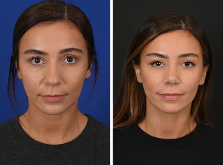 Rhinoplasty Costs Houston Texas Rhinoplasty Costs Houston Texas