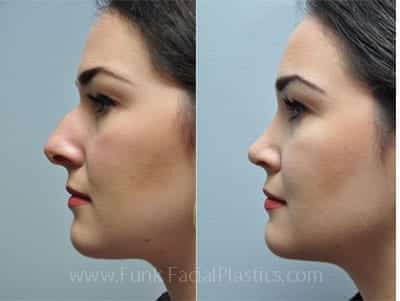 Rhinoplasty Costs Houston Texas Rhinoplasty Costs Houston Texas